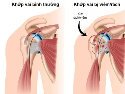 khop vai.jpg