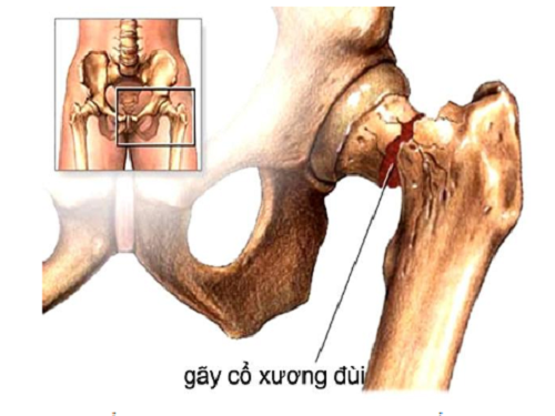 1gay_co_xuong_dui.max-800x800.png