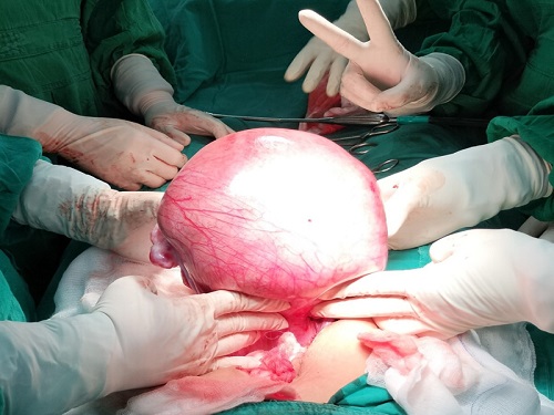 khối u 1,8 kg.jpg